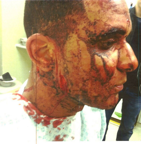 Francesco-Hounye-injuries (1)